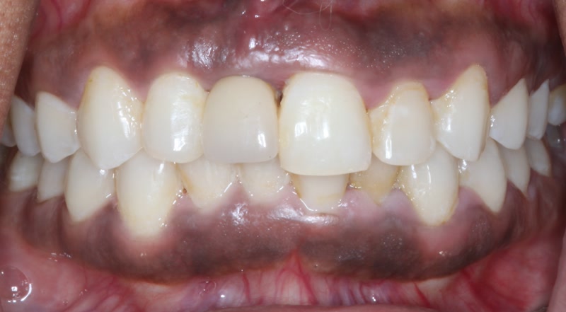 DH Dental   Prosthodontics | Cleanings   Exams, Crowns and Dental Implants