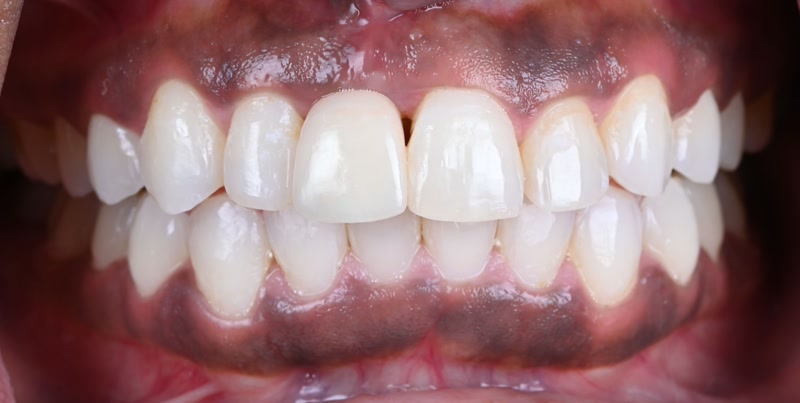 DH Dental   Prosthodontics | Full Mouth Reconstruction, Crowns and Veneers