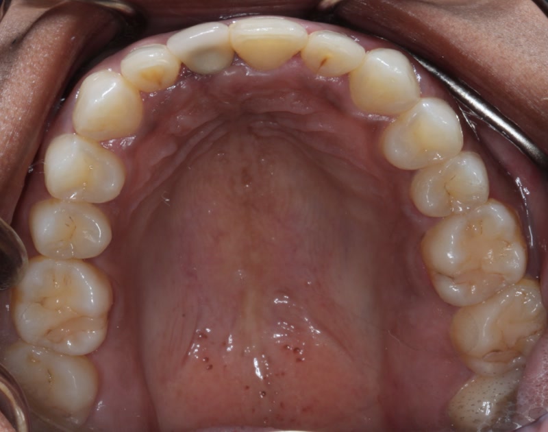 DH Dental   Prosthodontics | Full Mouth Reconstruction, Dentures and Crowns
