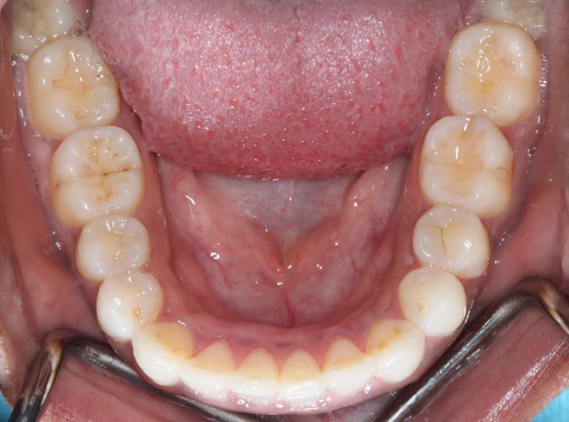 DH Dental   Prosthodontics | Veneers, Full Mouth Reconstruction and Crowns