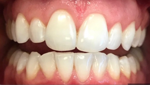 DH Dental   Prosthodontics | Botox, Night Guards and Spark trade  Clear Aligners