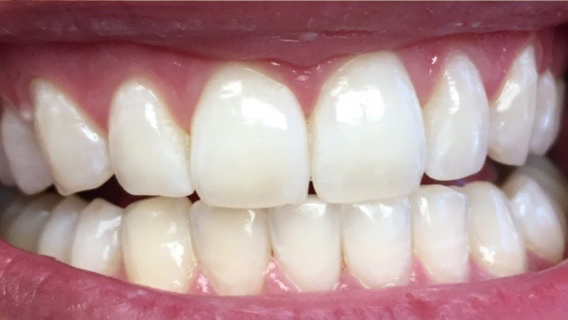 DH Dental   Prosthodontics | Full Mouth Reconstruction, Sports Mouthguards and Crowns