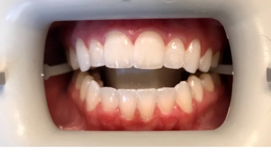 DH Dental   Prosthodontics | Spark trade  Clear Aligners, Snoring Treatment and Digital Impressions