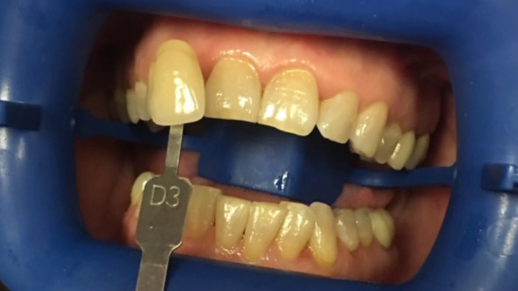 DH Dental   Prosthodontics | Spark trade  Clear Aligners, Teeth Whitening and Digital Radiography