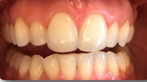 DH Dental   Prosthodontics | Botox, Spark trade  Clear Aligners and Snoring Treatment