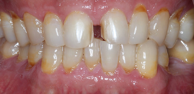 DH Dental   Prosthodontics | Spark trade  Clear Aligners, TMJ TMD and Emergency Treatment