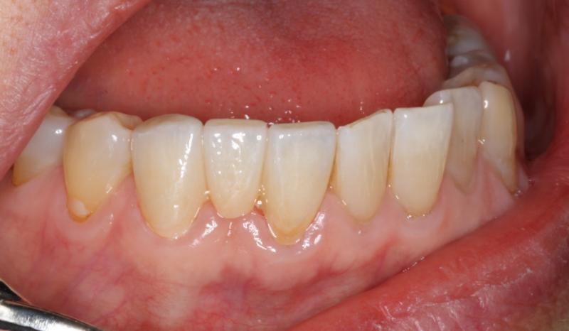 DH Dental   Prosthodontics | Invisalign reg , Dentures and Snoring Treatment