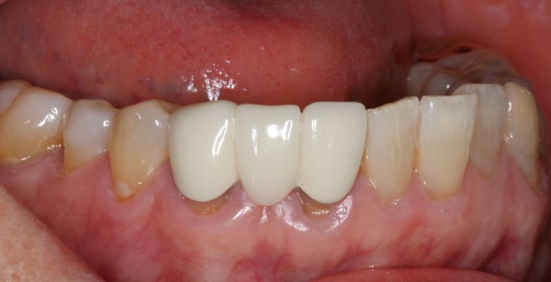 DH Dental   Prosthodontics | Spark trade  Clear Aligners, Veneers and Emergency Treatment