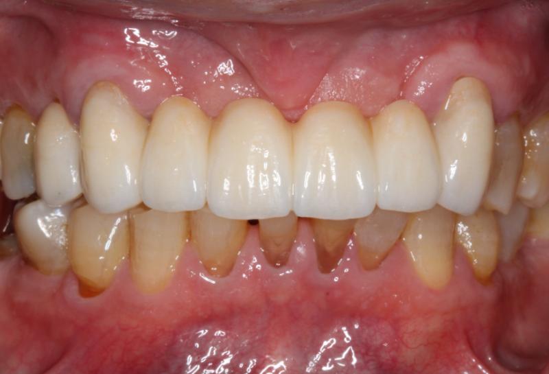 DH Dental   Prosthodontics | Invisalign reg , Botox and Night Guards