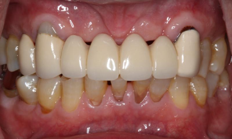 DH Dental   Prosthodontics | Veneers, Botox and Periodontal Treatment