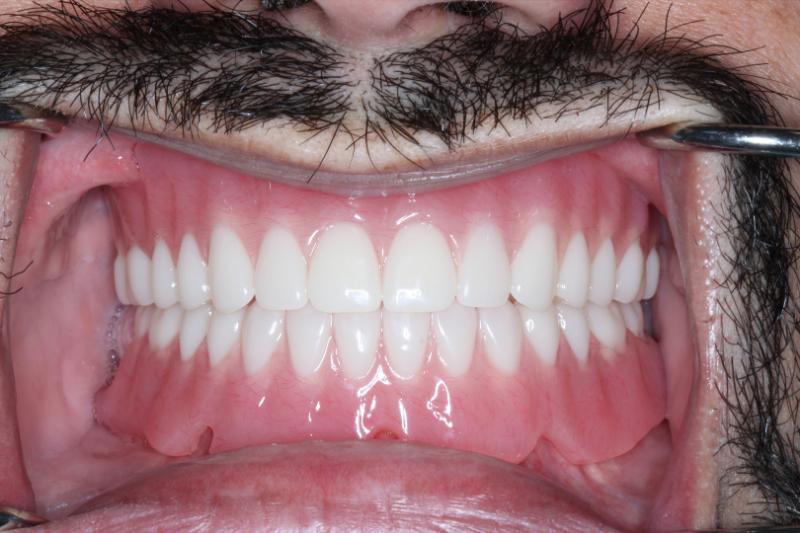 DH Dental   Prosthodontics | Snoring Treatment, Full Mouth Reconstruction and Teeth Whitening