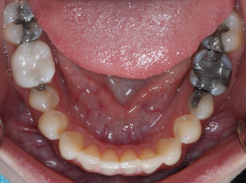 DH Dental   Prosthodontics | Dentures, Dental Bridges and Botox