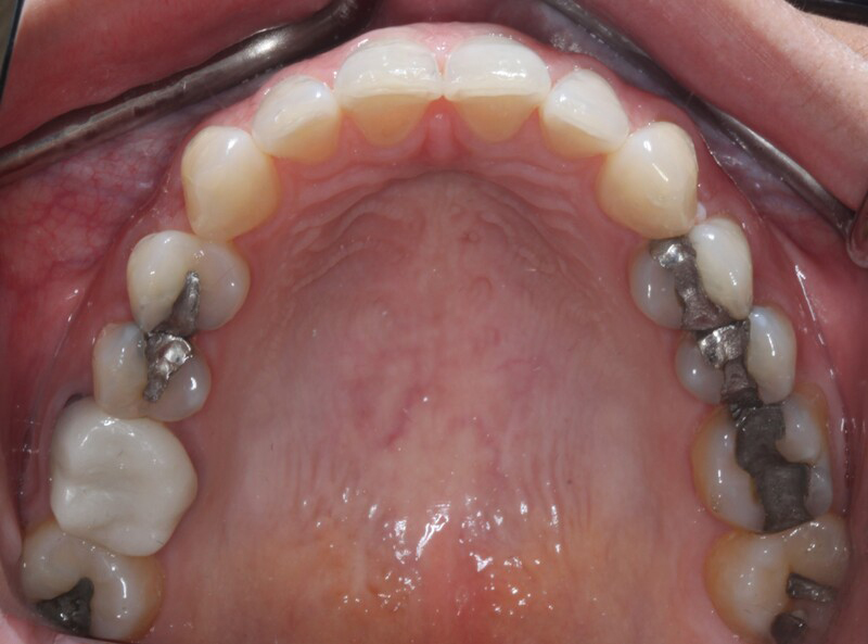 DH Dental   Prosthodontics | Dental Bridges, All-on-X and Cleanings   Exams