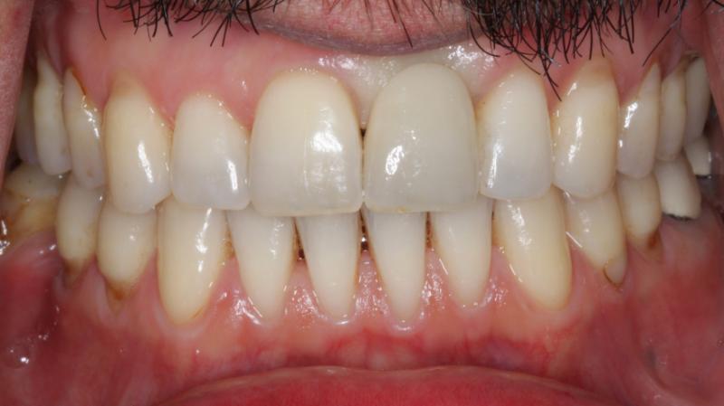 DH Dental   Prosthodontics | Dental Bridges, Sports Mouthguards and Crowns