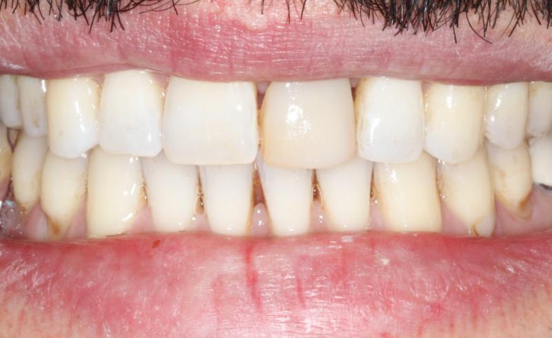 DH Dental   Prosthodontics | Dental Implants, Snoring Treatment and Crowns
