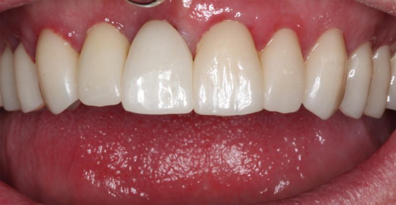 DH Dental   Prosthodontics | Dental Implants, Oral Cancer Screening and Botox