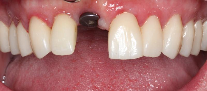 DH Dental   Prosthodontics | Night Guards, Invisalign reg  and Sports Mouthguards