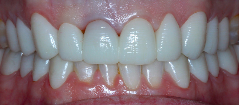 DH Dental & Prosthodontics | Dental Bridges, TMJ/TMD and Dental Implants