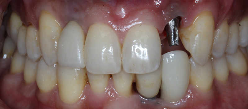 DH Dental & Prosthodontics | Cleanings & Exams, Veneers and Oral Exams