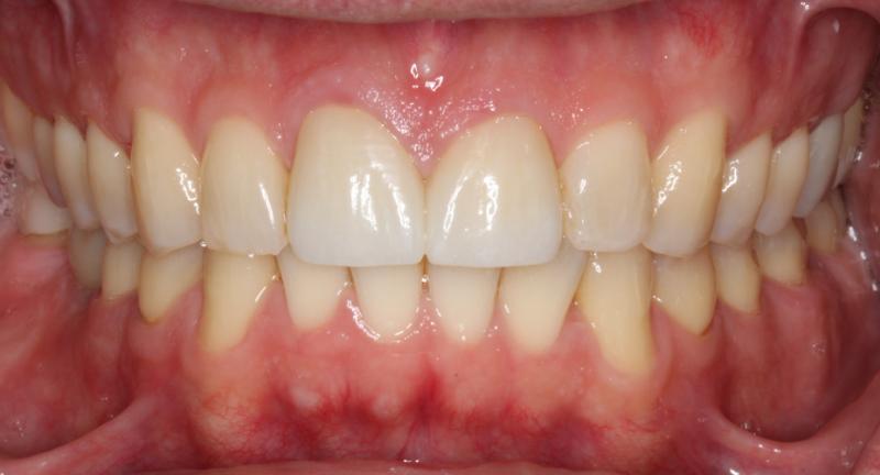 DH Dental Prosthodontics | Botox, TMJ TMD and Emergency Treatment