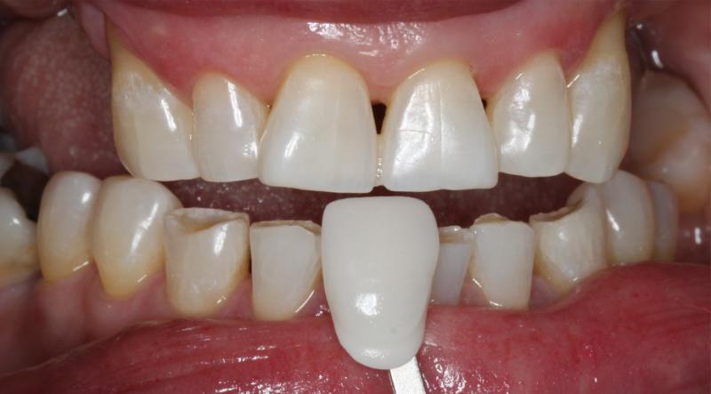 DH Dental   Prosthodontics | Full Mouth Reconstruction, Oral Cancer Screening and Digital Radiography