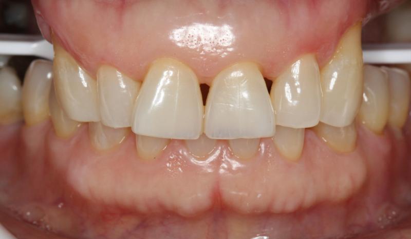 DH Dental   Prosthodontics | Botox, Night Guards and Dental Bridges