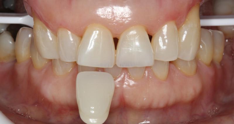 DH Dental   Prosthodontics | Crowns, Cleanings   Exams and Teeth Whitening