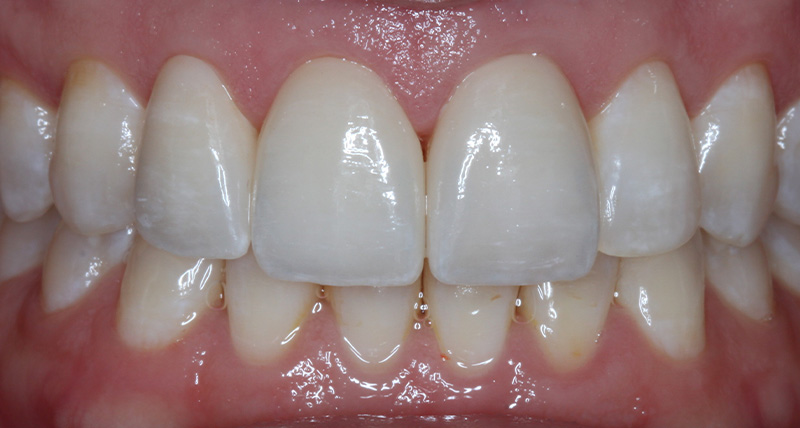 DH Dental & Prosthodontics | Sports Mouthguards, Dental Bridges and Spark&trade; Clear Aligners