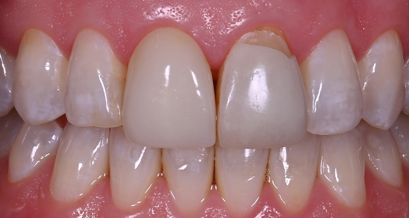 DH Dental & Prosthodontics | Night Guards, Botox and TMJ/TMD