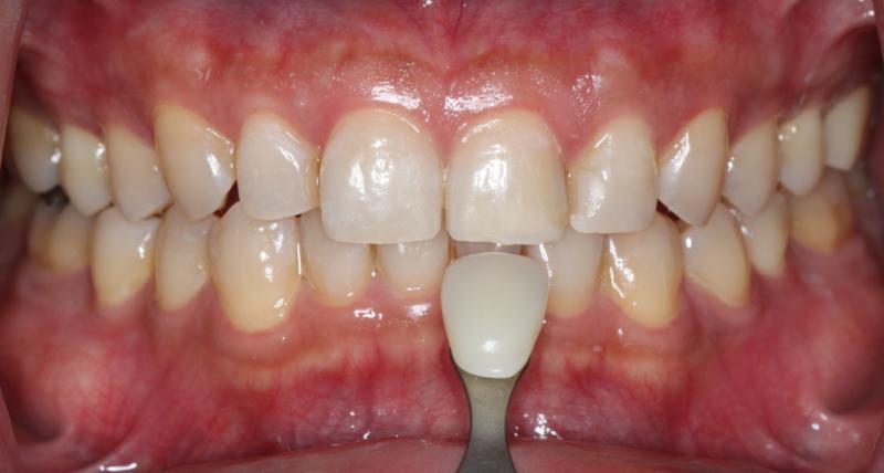 DH Dental   Prosthodontics | TMJ TMD, Periodontal Treatment and Preventative Care Program