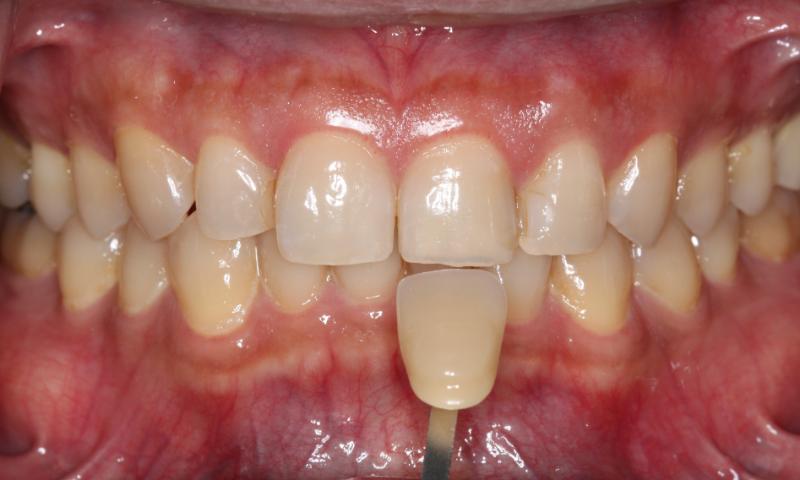 DH Dental   Prosthodontics | Teeth Whitening, Dentures and Spark trade  Clear Aligners