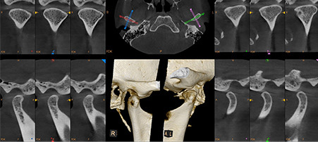 DH Dental   Prosthodontics | Oral Cancer Screening, Teeth Whitening and TMJ TMD