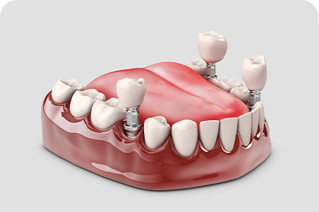 DH Dental   Prosthodontics | Dental Implants, Dentures and Full Mouth Reconstruction