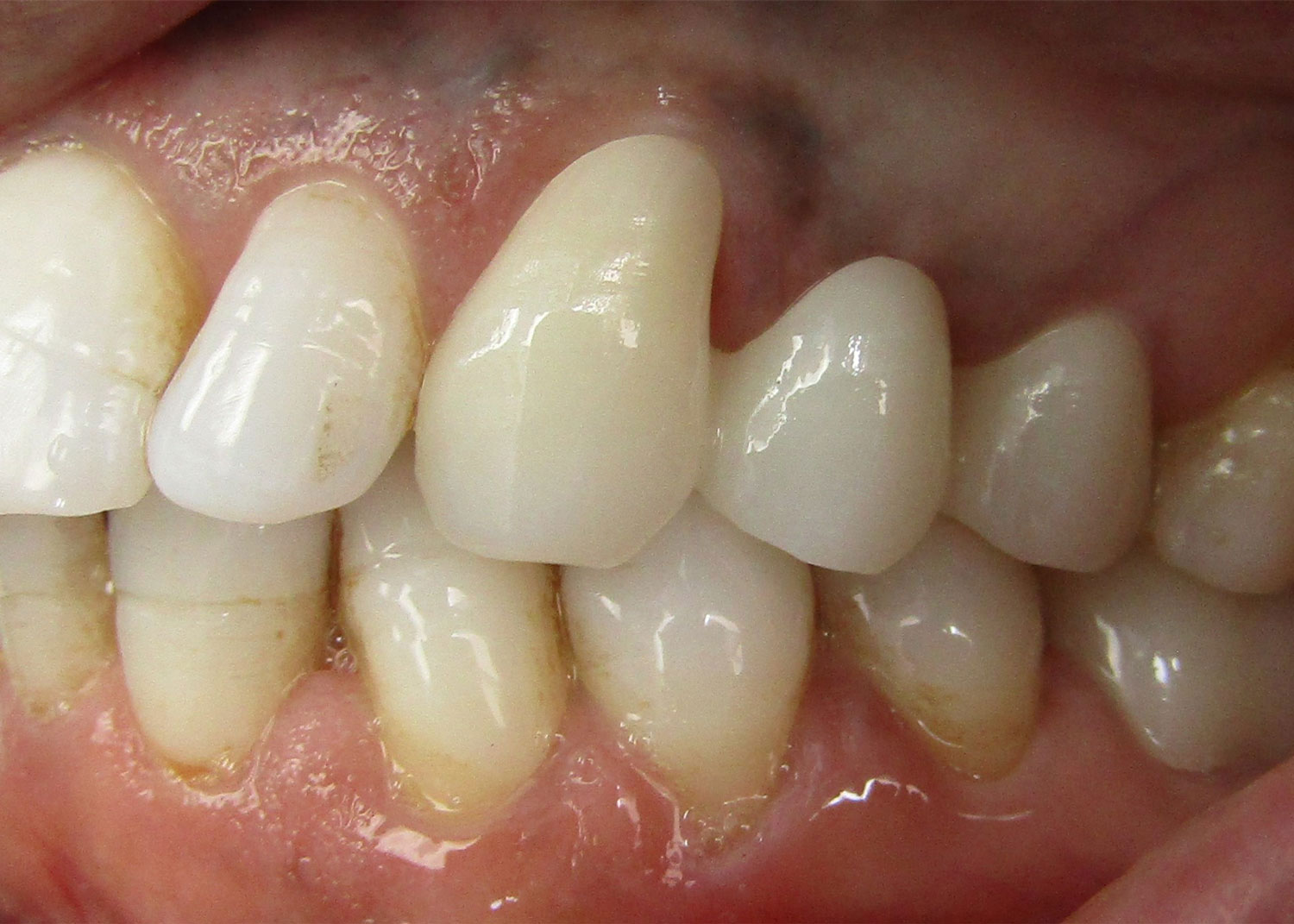 DH Dental Prosthodontics | Veneers, Full Mouth Reconstruction and Cleanings Exams